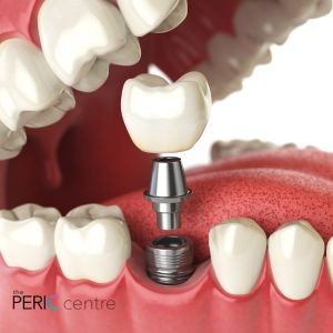 Understanding the Importance of Osseointegration for Dental Implants