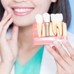 How Long Do Dental Implants Actually Last?