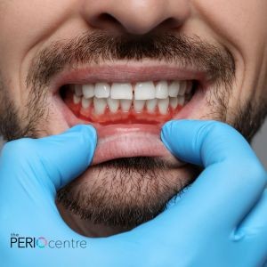 Why Your Dentist May Recommend You to a Periodontist in Whitby