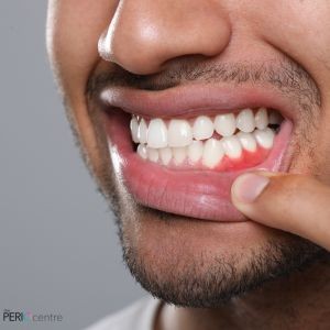 Why You Need More Than a Cleaning to Treat Gum Disease