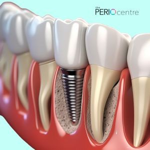 dental implant Oshawa