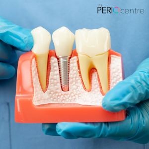 dental implants oshawa
