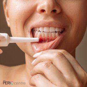 periodontal flap surgery