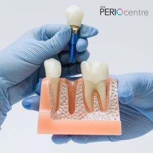 dental implants oshawa