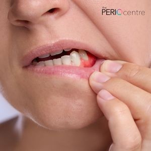 treatment for gum disease