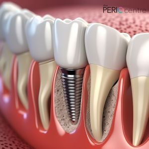 dental implants oshawa