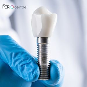 Guide to Post-Dental Implant Recovery