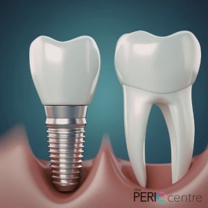 dental implants whitby