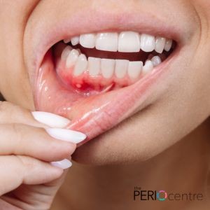 chewing tobacco and gum recession How Smoking Can Trigger Gum Recession