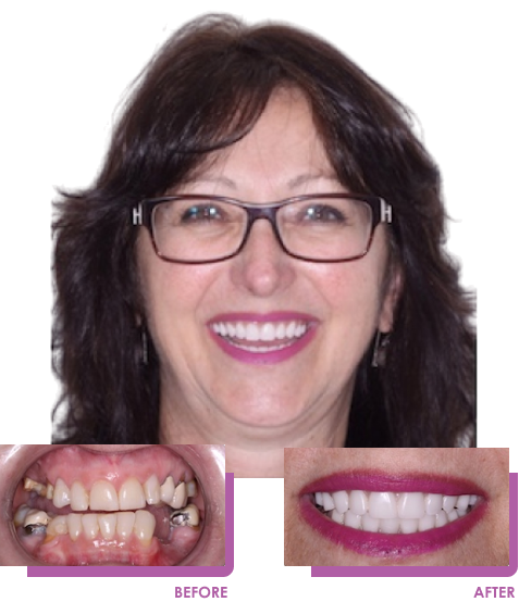 Dental Implants Before & After